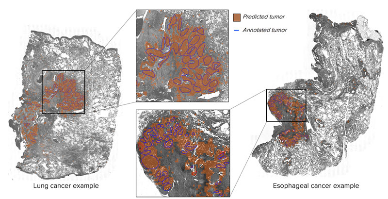 Human pathologists marked tumor regions in blue circles, machine-vision automatically annotated regions in orange